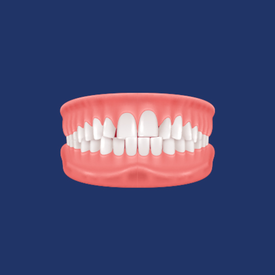 A model of overcrowded teeth on a blue background